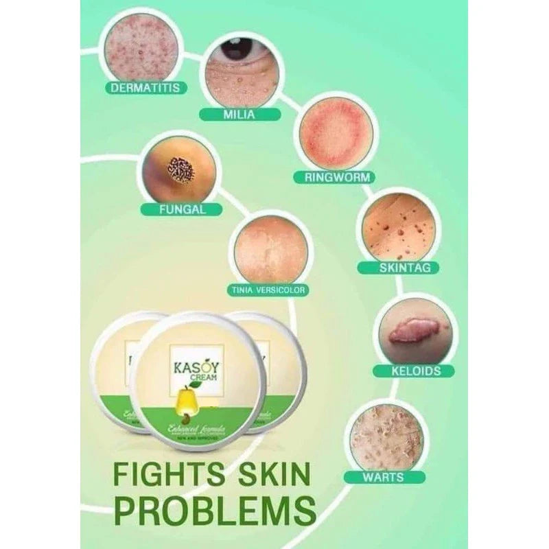 Kasoy Cream Warts Remover Angel Touch - 5g