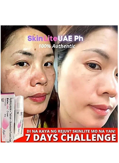 Skinlite Cream – Hydroquinone, Tretinoin and Mometasone Formula