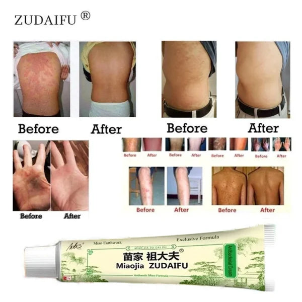 Miaojia Zudaifu Antibacterial Cream – Authentic Miao Formula (15g)